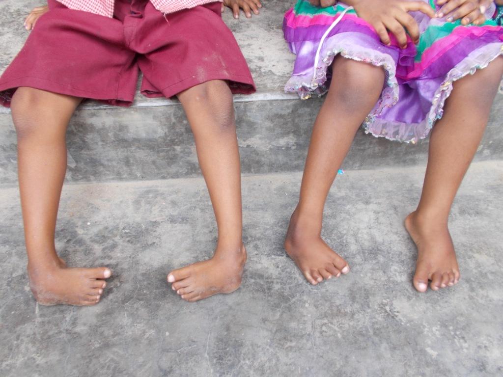 Children sitting on concrete steps, below knee view shows their feet affected by clubfoot as they are turned inwards