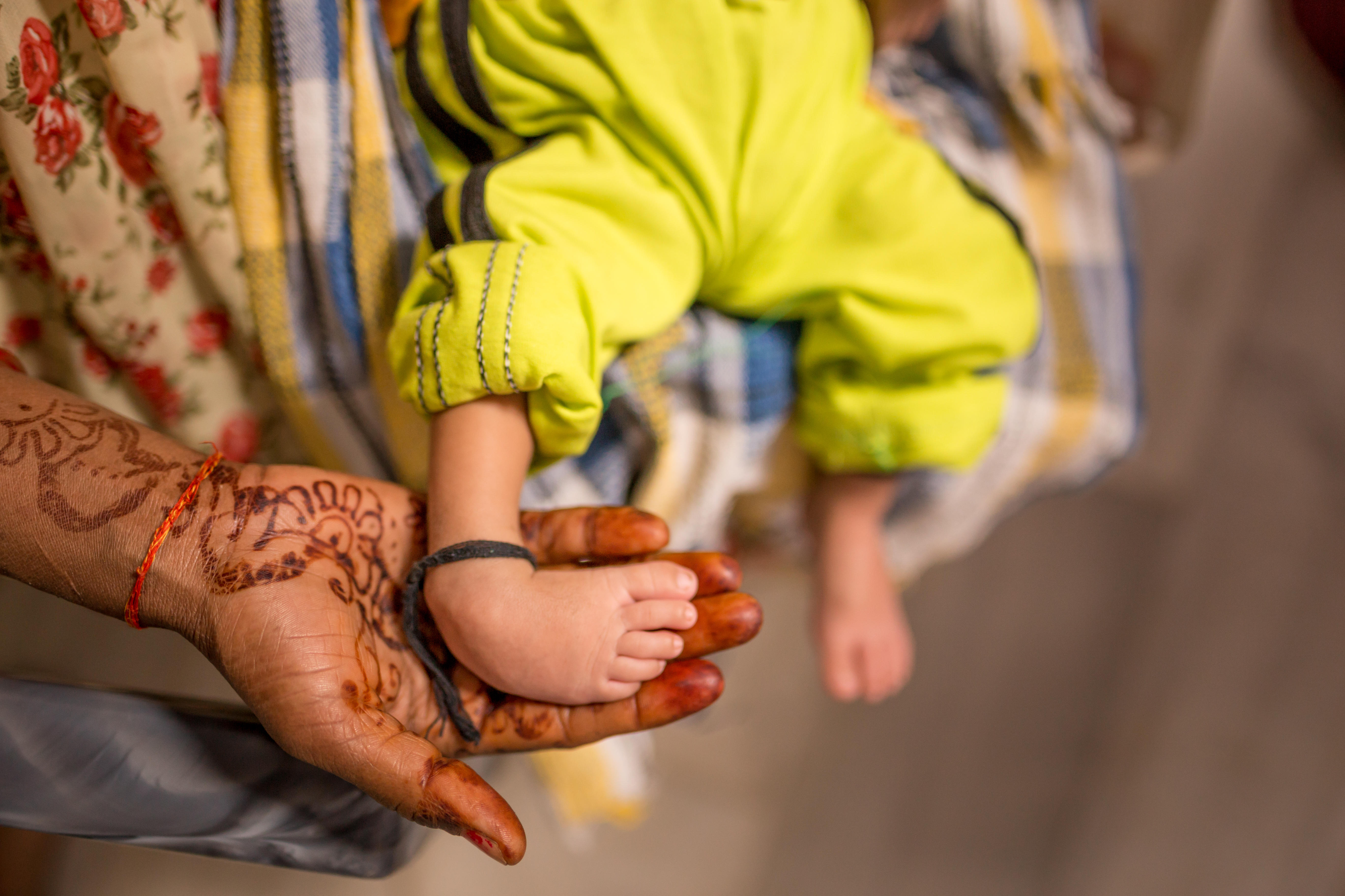 A woman holding the a baby's foot up affected by clubfoot condition